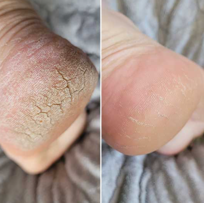 PureFormBeauty™ Callus Remover
